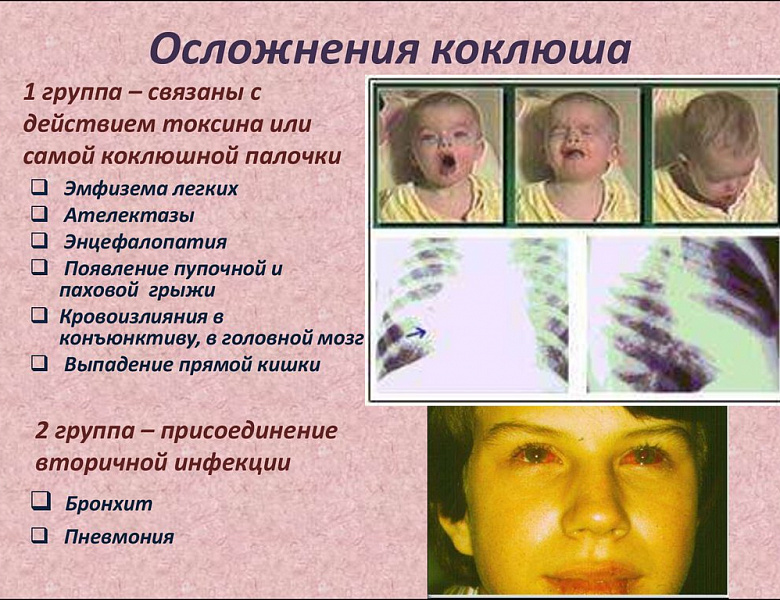 Осторожно, коклюш!